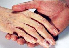 怎樣去掉手上的老年斑？還會(huì)再生嗎？