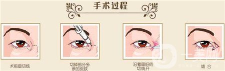 韓式開眼角多少錢？普遍價(jià)位是多少？