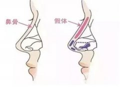 假體隆鼻多久可以修復(fù)?用什么材料修復(fù)?