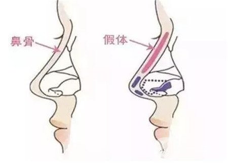 假體隆鼻多久可以修復?用什么材料修復?