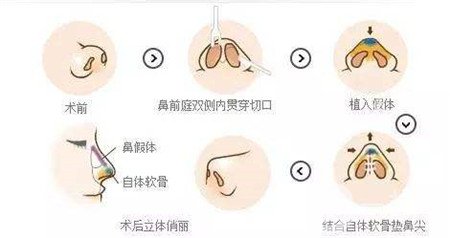 假體隆鼻多久可以修復?用什么材料修復?