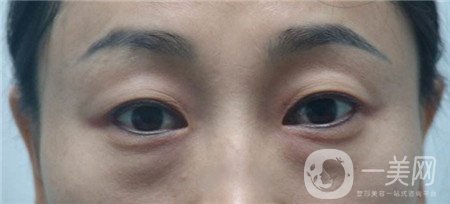 內(nèi)切去眼袋多長(zhǎng)時(shí)間恢復(fù)?期間需要注意什么?