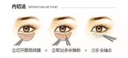 內(nèi)切去眼袋多長(zhǎng)時(shí)間恢復(fù)?期間需要注意什么?