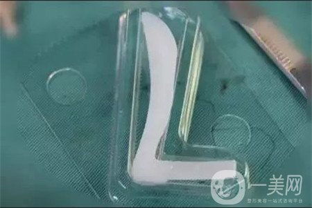膨體隆鼻缺點是什么？優(yōu)點有哪些？