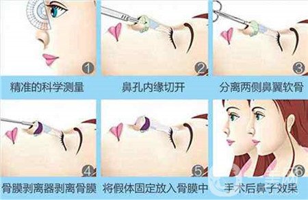 膨體隆鼻術(shù)后注意事項有哪些？需要忌口嗎？