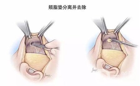 去頰脂墊幾天消腫?多久才能正常吃飯?