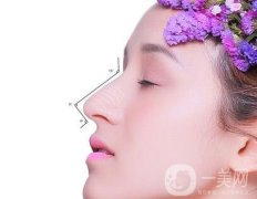 做完鼻部手術(shù)多久能見人?多久能完全消腫?