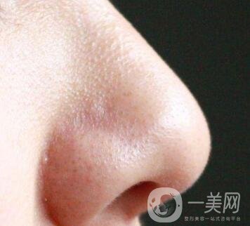 鼻子長(zhǎng)黑頭怎么辦？做激光有用嗎？