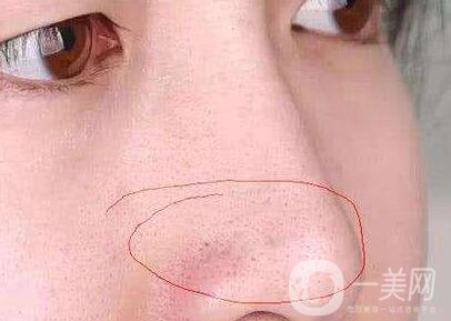 鼻子長(zhǎng)黑頭怎么辦？做激光有用嗎？
