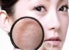 果酸嫩膚果如何?皮膚很黑適合做嗎?