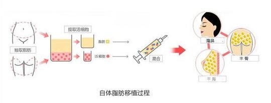 自體脂肪隆鼻術(shù)前準(zhǔn)備你必須要知道!