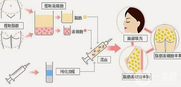 自體脂肪填充的價格是怎么計費的?