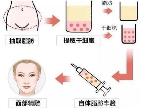 自體脂肪填充恢復(fù)期要多久?可以側(cè)身睡嗎?