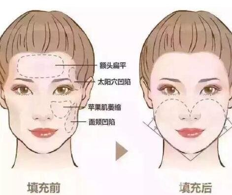 自體脂肪填充價(jià)格大概要多少錢?