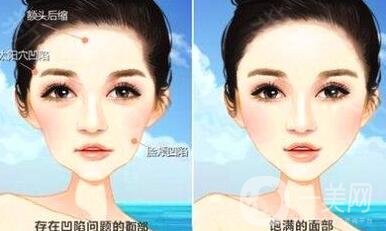 自體脂肪填充