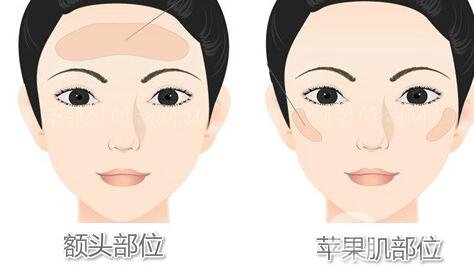 自體脂肪填充