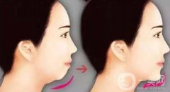 自體脂肪填充下巴費(fèi)用高嗎?收費(fèi)情況說(shuō)明