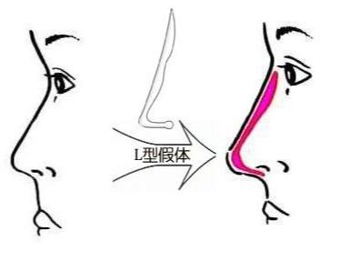 假體隆鼻