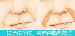自體脂肪填充鼻唇溝果好嗎?