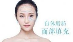 自體脂肪填充多久補(bǔ)打才自然?間隔時(shí)間說(shuō)明