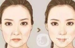 自體脂肪填充法令紋的危害是什么?
