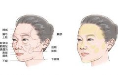 自體脂肪填充后多長(zhǎng)時(shí)間補(bǔ)第二次比較合適?