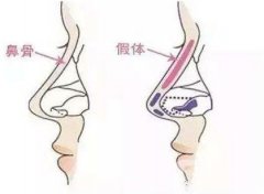 假體隆鼻會變形嗎?鼻子會凹陷下去嗎?