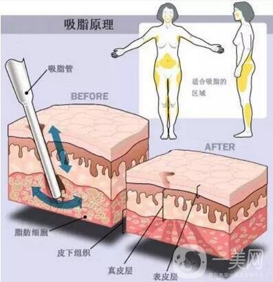腰腹部吸脂后多久消腫?要多久才不腫?