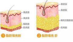 成都自體脂肪填充醫(yī)院有哪些?