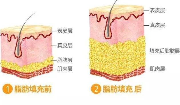 成都自體脂肪填充醫(yī)院有哪些?