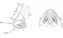 夏天做假體隆鼻好嗎?有沒有要注意的?