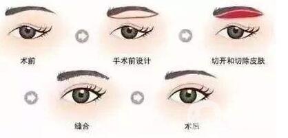 自體脂肪填充顳部能提升眼角嗎?