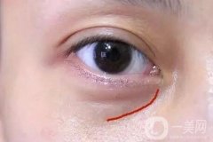 淚溝自體脂肪填充術(shù)后有些腫正常嗎?會(huì)恢復(fù)嗎?