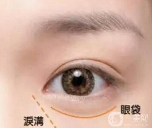 淚溝自體脂肪填充術后有些腫正常嗎?會恢復嗎?