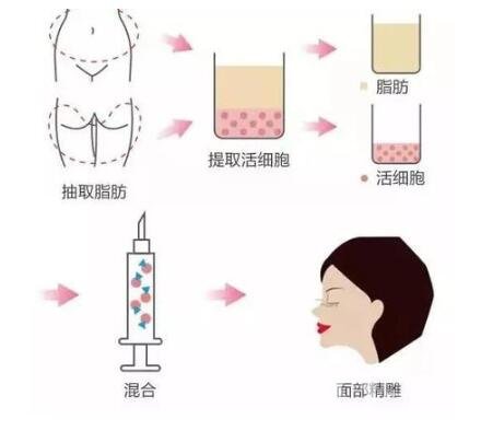 自體脂肪填充化瘀很慢怎么回事?要怎么做?