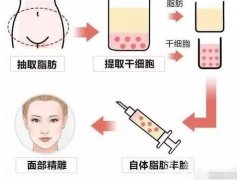 自體脂肪填充副作用及后遺癥是什么?