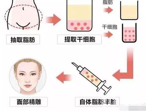 自體脂肪填充副作用及后遺癥是什么?