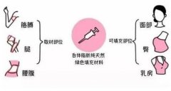自體脂肪填充介紹?全國哪些機構(gòu)做得好?