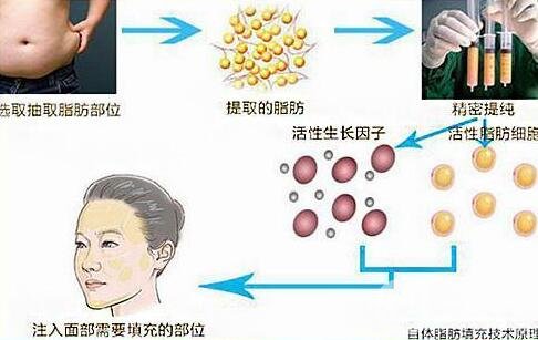自體脂肪填充介紹?全國(guó)哪些機(jī)構(gòu)做得好?