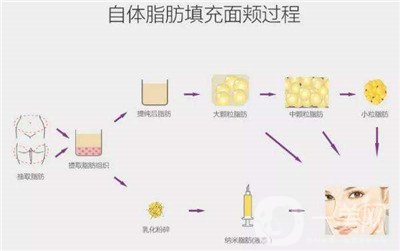 北京自體脂肪填充醫(yī)院有哪些？好的有哪些？