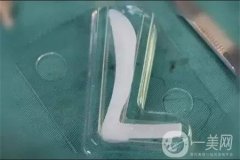 假體隆鼻果如何？多久可以看到果呢？
