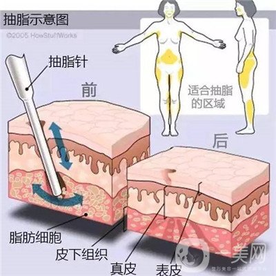 腰腹環(huán)吸后要腫多長(zhǎng)時(shí)間呢？可以活動(dòng)嗎？