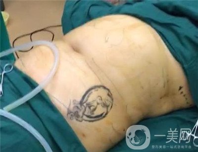 腰腹環(huán)吸后要腫多長(zhǎng)時(shí)間呢？可以活動(dòng)嗎？