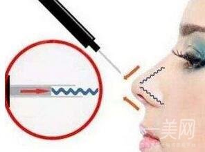 自體軟骨隆鼻整形疼嗎？*嗎？