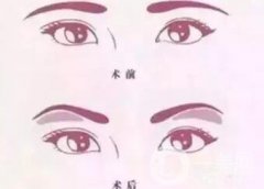 玻尿酸眉弓填充怎么打？會下滑嗎？