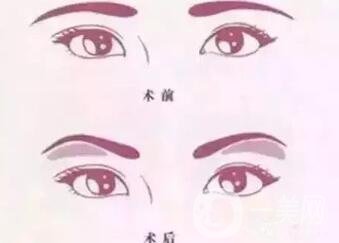 玻尿酸眉弓填充怎么打？會下滑嗎？