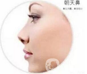 朝天鼻怎么整形？手術(shù)神秘面紗揭幕