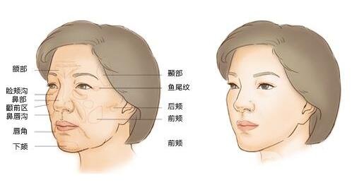 自體脂肪填充要注意什么?術后怎么護理?