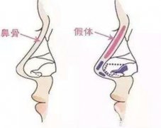 假體隆鼻需要多少錢?進口的要多少錢?