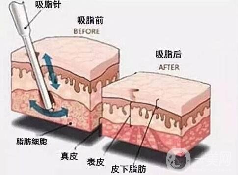 大腿吸脂第五天開始爆腫是醫(yī)生打腫脹液的緣故嗎?